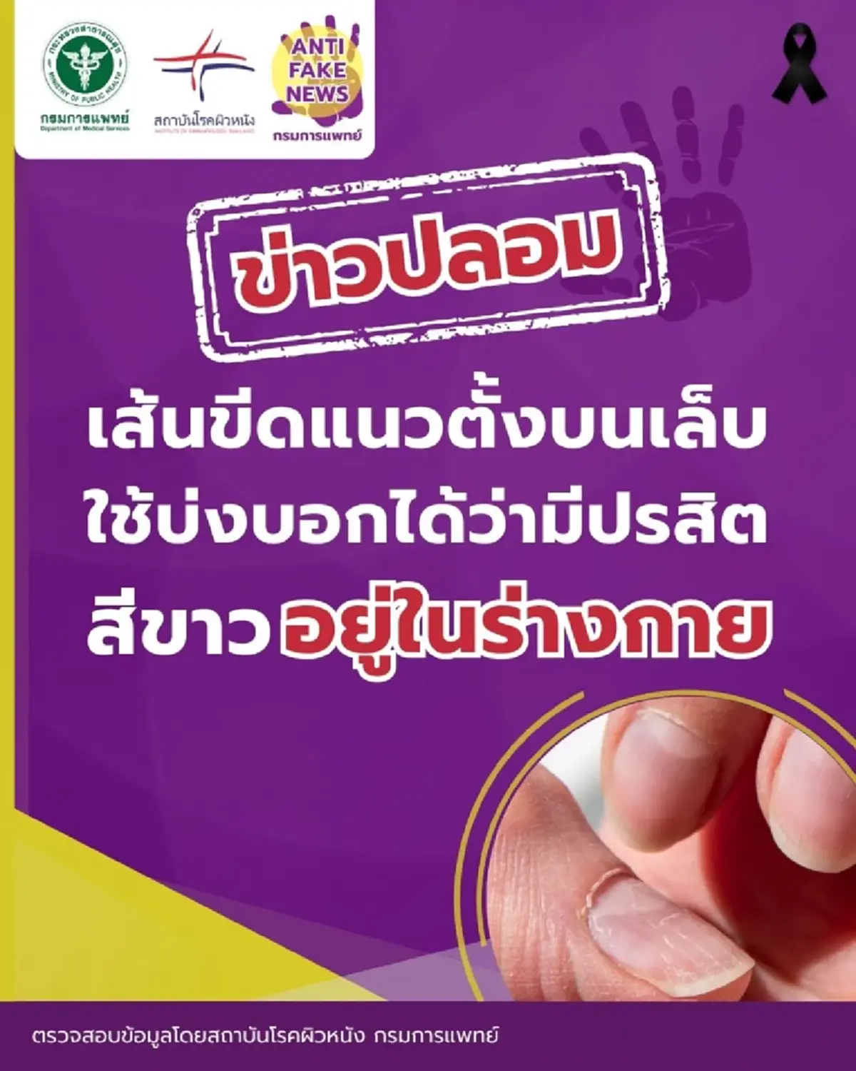 ยืนยันแล้ว “เส้นขีดบนเล็บ คือ มีปรสิตสีขาวในร่างกาย” จริงหรือ