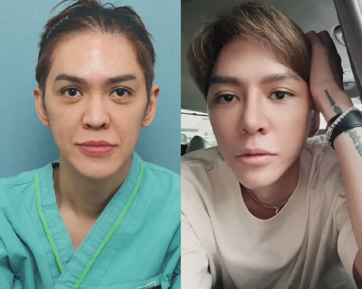 ดัง พันกร  เปิดลุคใหม่หลังศัลยกรรมใหญ่ หน้าเด็กจนแฟนคลับตะลึง