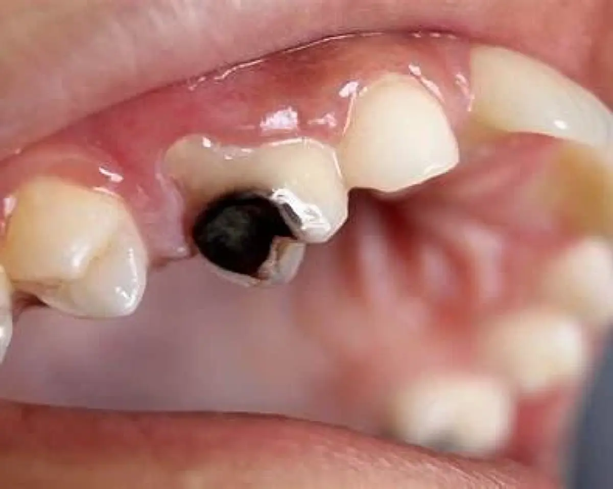 ฟันผุอย่ามองข้าม! ภัยใกล้ตัวที่อาจลุกลามถึงสุขภาพทั้งร่างกาย