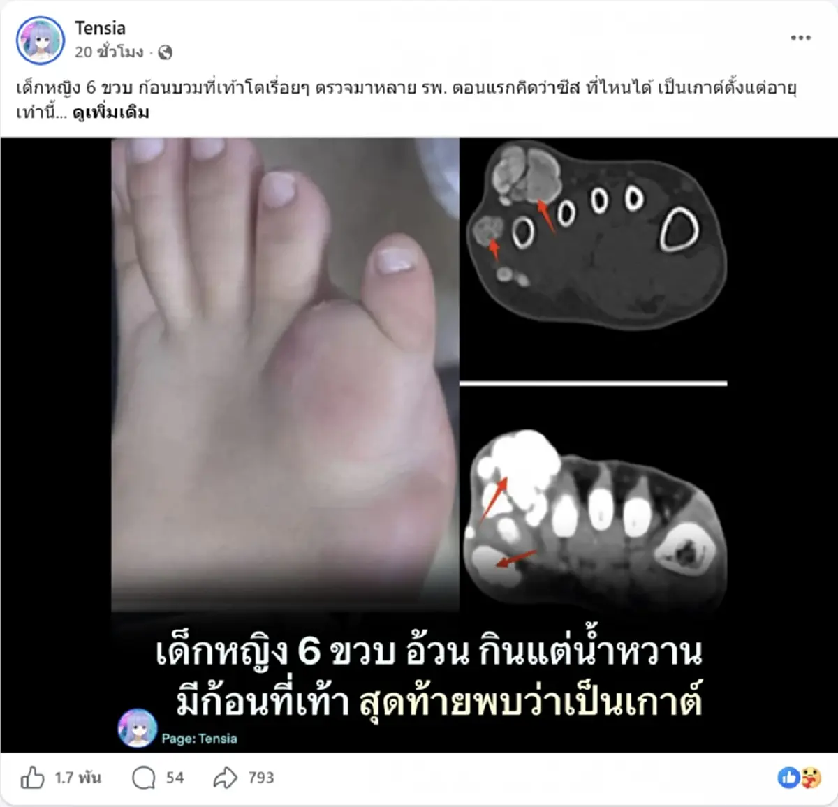 เด็ก 6 ขวบ มีก้อนบวมที่เท้า ก่อนรู้ผลตรวจ เป็นตั้งแต่อายุยังน้อย