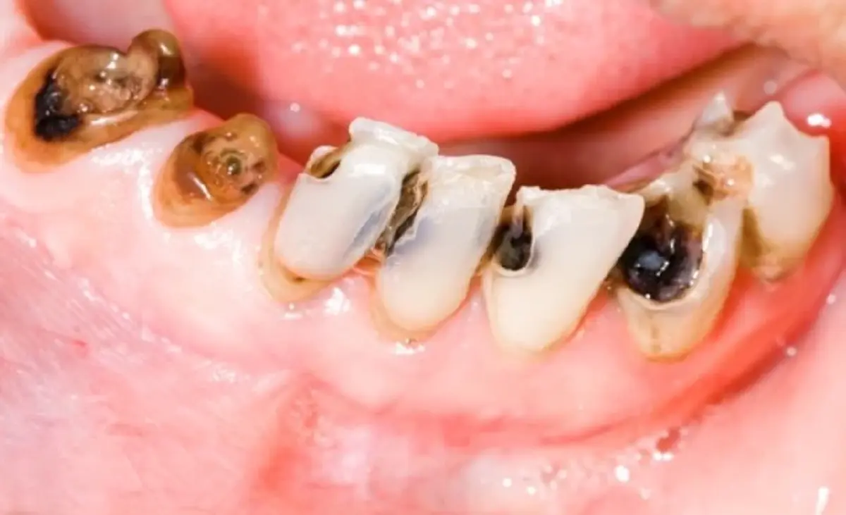 ฟันผุอย่ามองข้าม! ภัยใกล้ตัวที่อาจลุกลามถึงสุขภาพทั้งร่างกาย