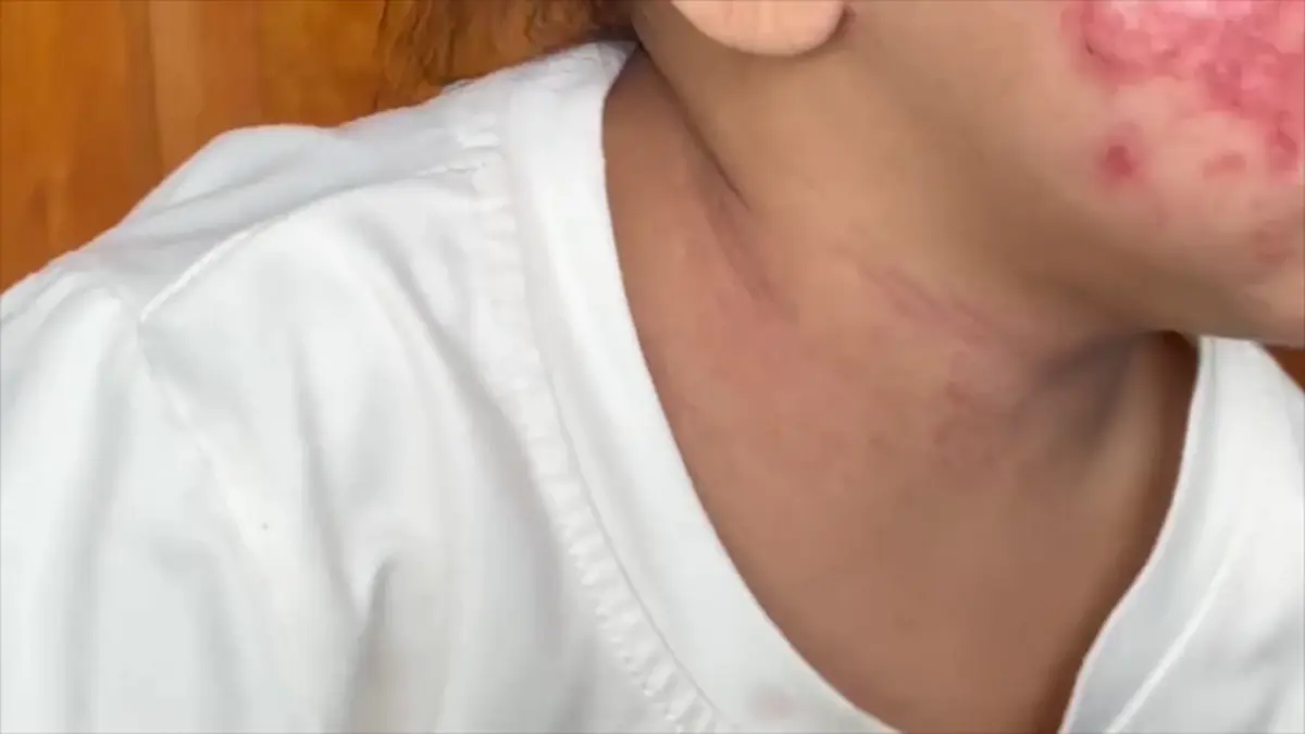 พ่ออัดคลิปแฉเพื่อนบ้านฉีดยาฆ่าหญ้า ลมพัดทำลูก 2 ขวบแพ้รุนแรง