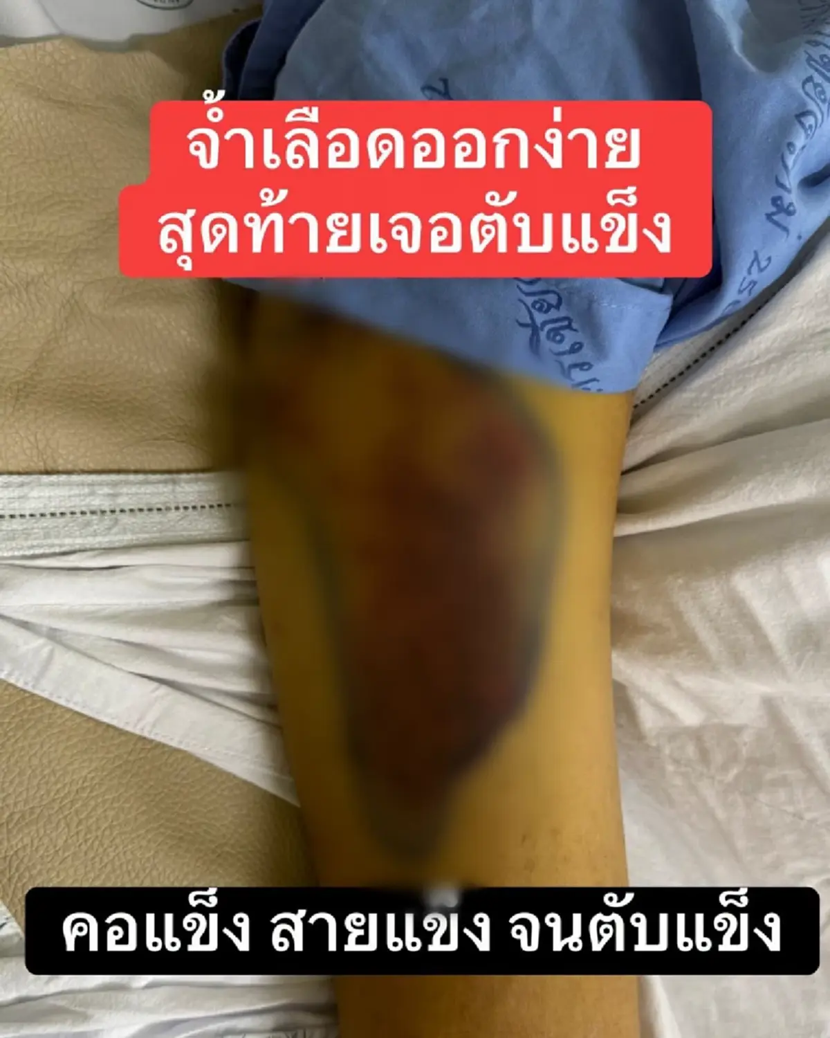 หมอ ยกเคสเตือนสายดื่ม ภาวะตับแข็ง อาการแบบนี้ควรรีบตรวจ