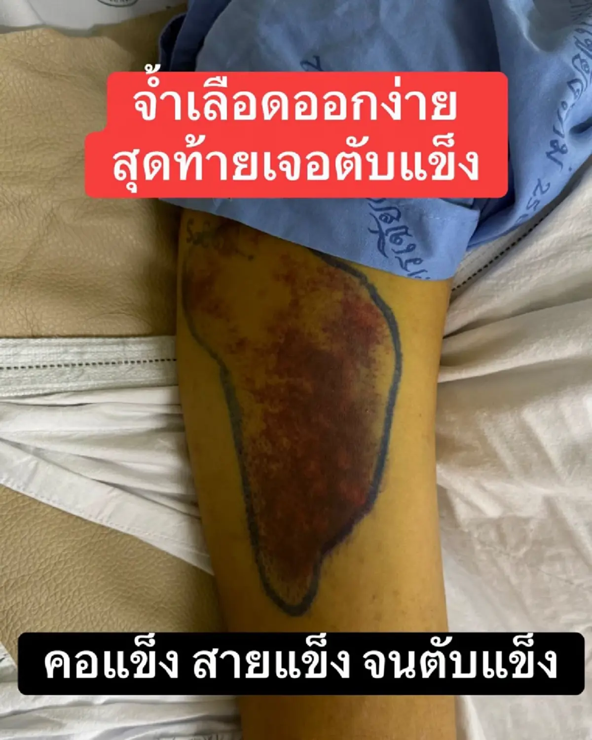 หมอเปิดเคส "จ้ำเลือด-เข่าบวม"  เตือน สัญญาณอันตรายสายดื่ม