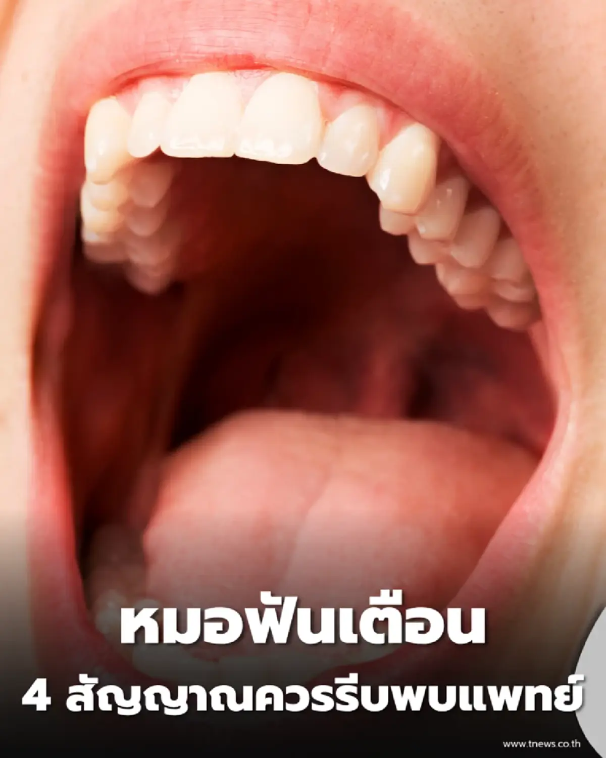 หมอฟันเผย 4 อาการเตือนมะเร็งในช่องปาก ถ้ามีแผลไม่หายรีบพบแพทย์