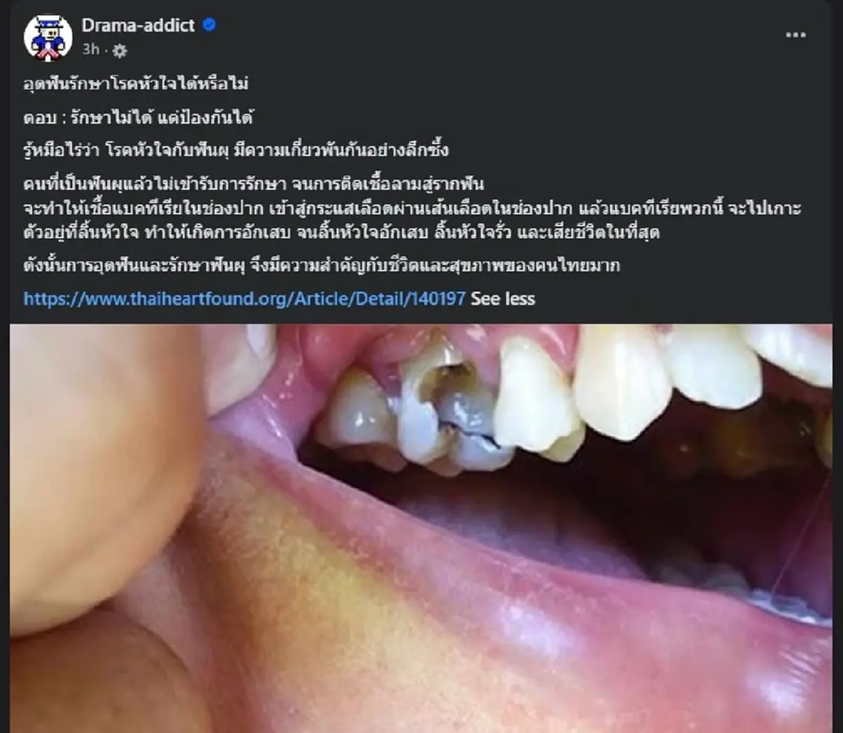 เปิดเหตุผลถึงบางอ้อ ทำไมการ "อุดฟัน" ถึงป้องกัน "โรคหัวใจ" ได้ 