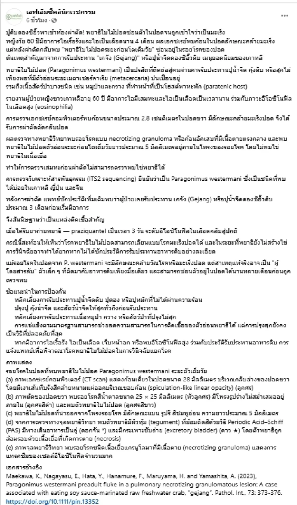 ปูดิบดองซีอิ๊วเป็นเหตุ หญิงวัย60 ไอเป็นเลือด เรื้อรังนาน 4 เดือน