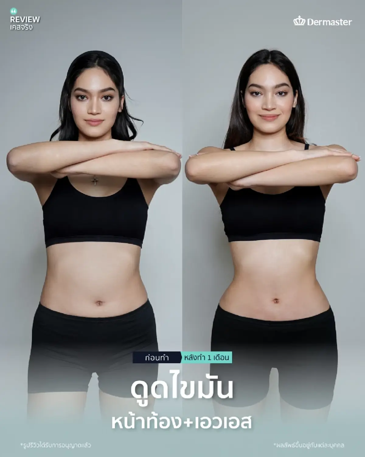 ดูดไขมันที่ไหนดี เห็นผลชัดเจน
