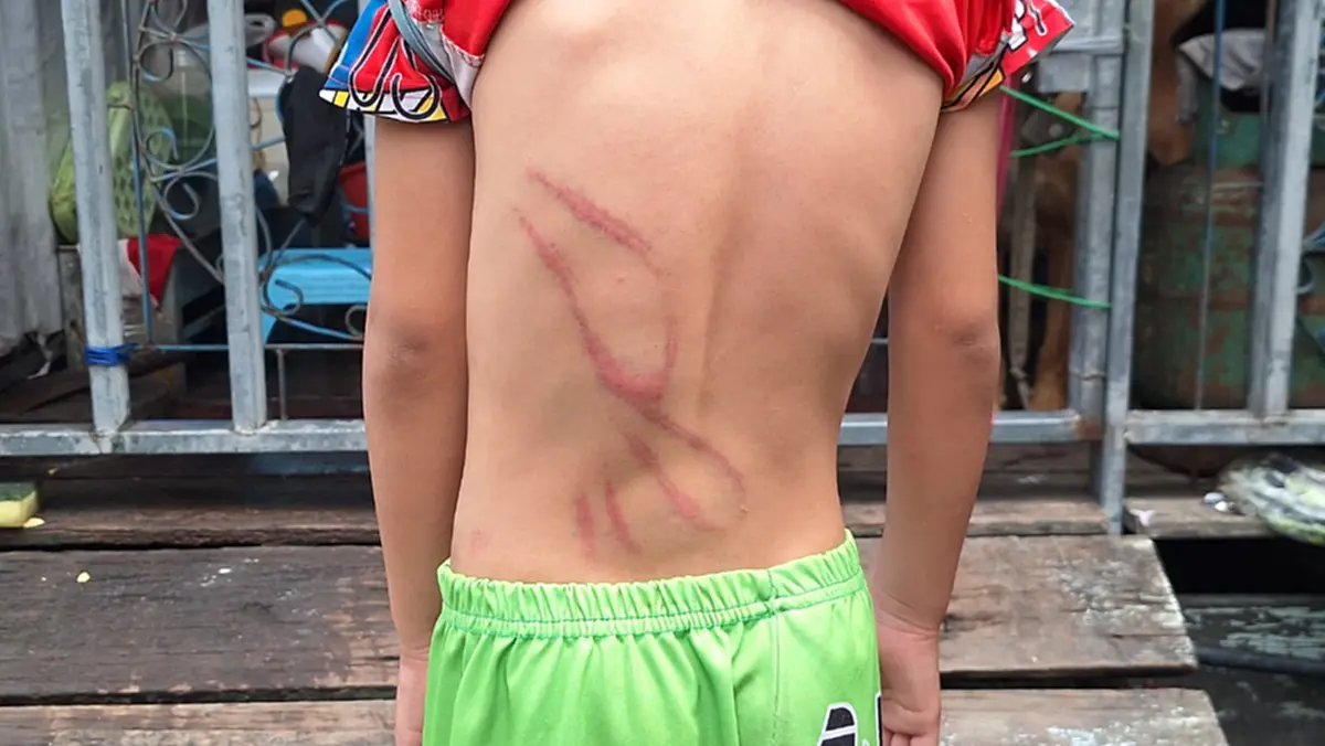 พ่อเลี้ยงโหดใช้ไม้แขวนเสื้อฟาดเด็ก 5 ขวบน่วม ก่อนซิ่งหนี