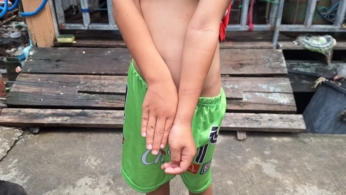 พ่อเลี้ยงโหดใช้ไม้แขวนเสื้อฟาดเด็ก 5 ขวบน่วม ก่อนซิ่งหนี