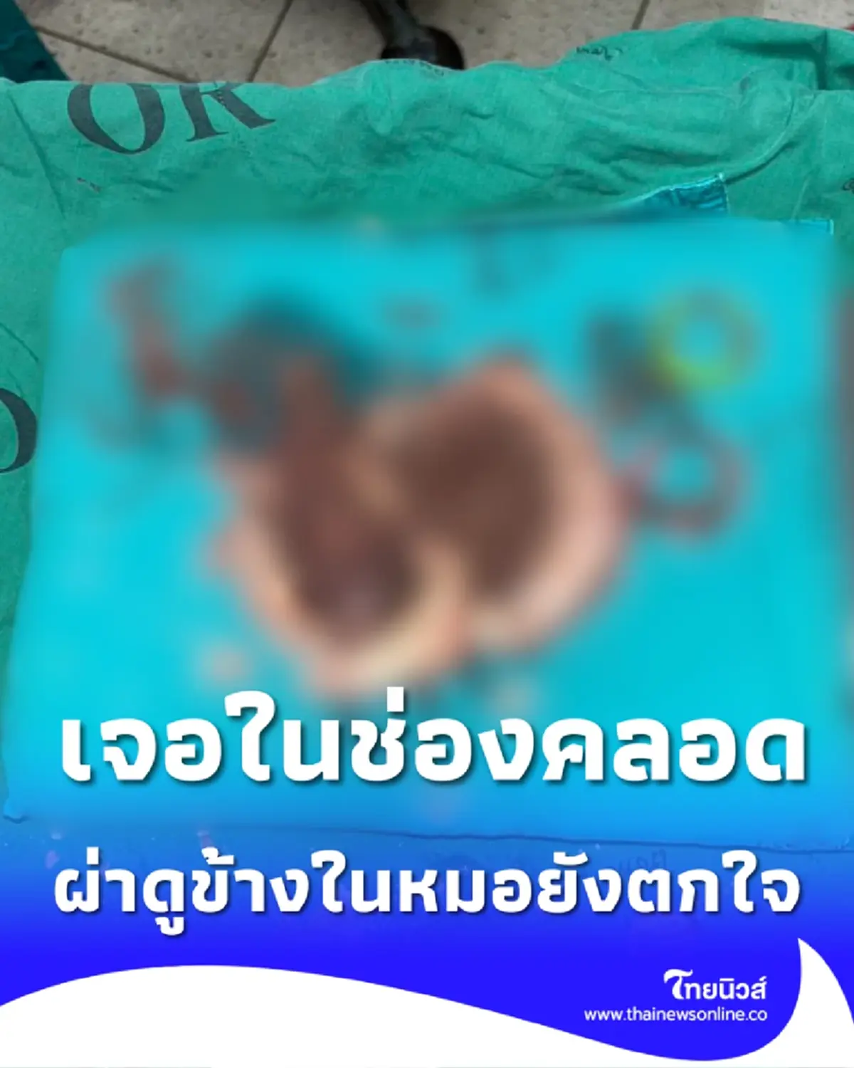 ขนลุก รู้แล้ว สิ่งที่อยู่ข้างในคืออะไร ทำหญิงวัย 47 ปี ปวดท้อง 3 ปี