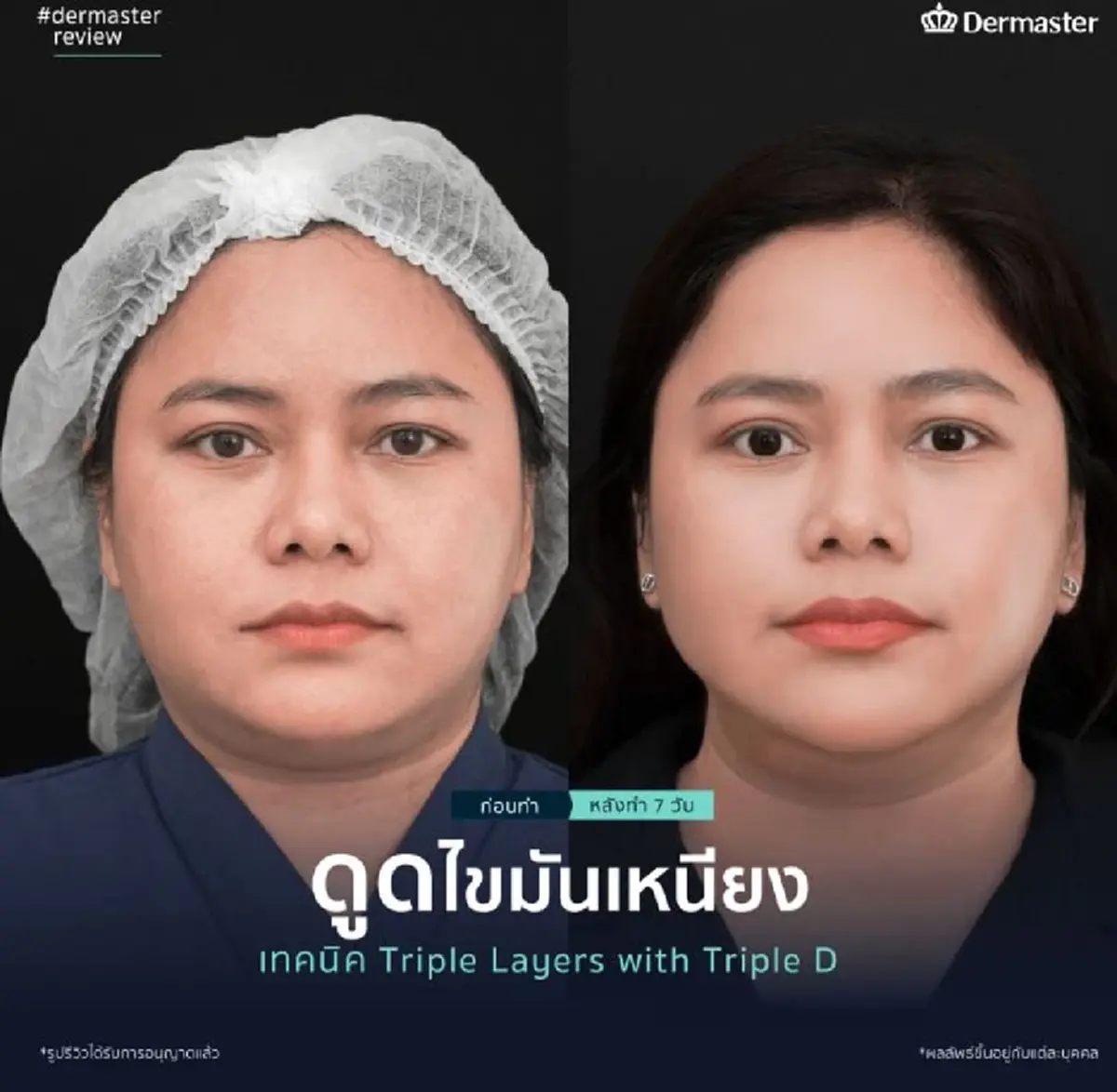  เตรียมตัวดูดไขมันเหนียง