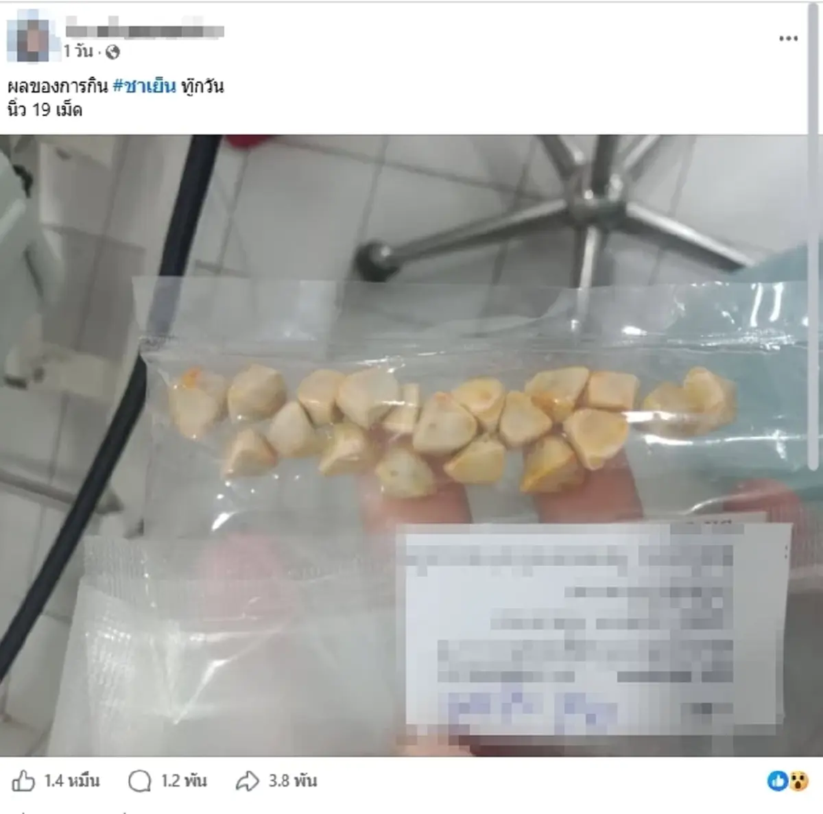 ถึงว่า สาวกินชาเย็นทุกวัน สุดท้ายผ่านิ่ว 19 เม็ด แถมต้องผ่าซ้ำอีก