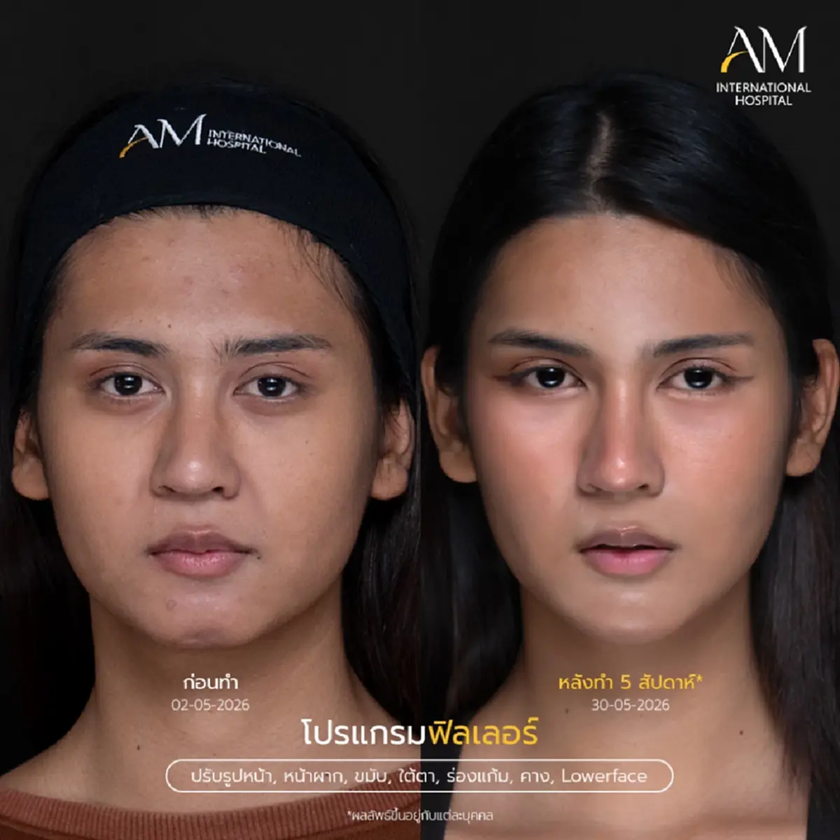 รีวิว"คุณลูกพลับ" ปรับลุคใหม่ในรายการ Surgery Wars