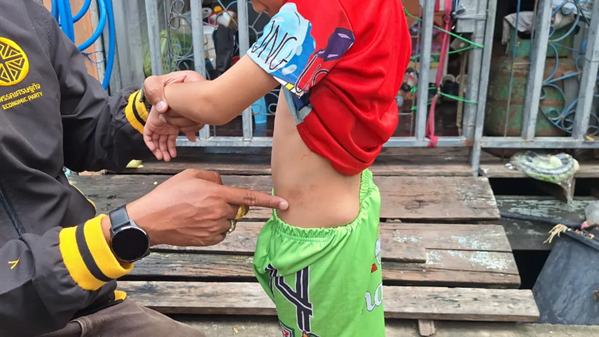 พ่อเลี้ยงโหดใช้ไม้แขวนเสื้อฟาดเด็ก 5 ขวบน่วม ก่อนซิ่งหนี