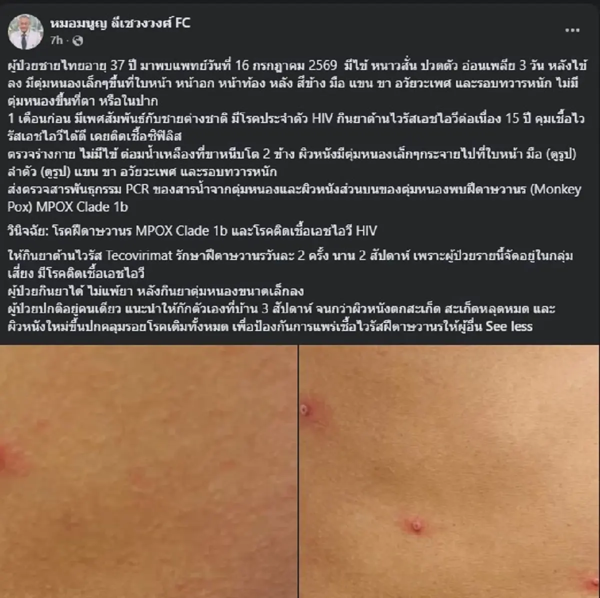 หมอเปิดเคส "ชายวัย 37" ติดเชื้อฝีดาษวานรสายพันธุ์ MPOX Clade 1b 