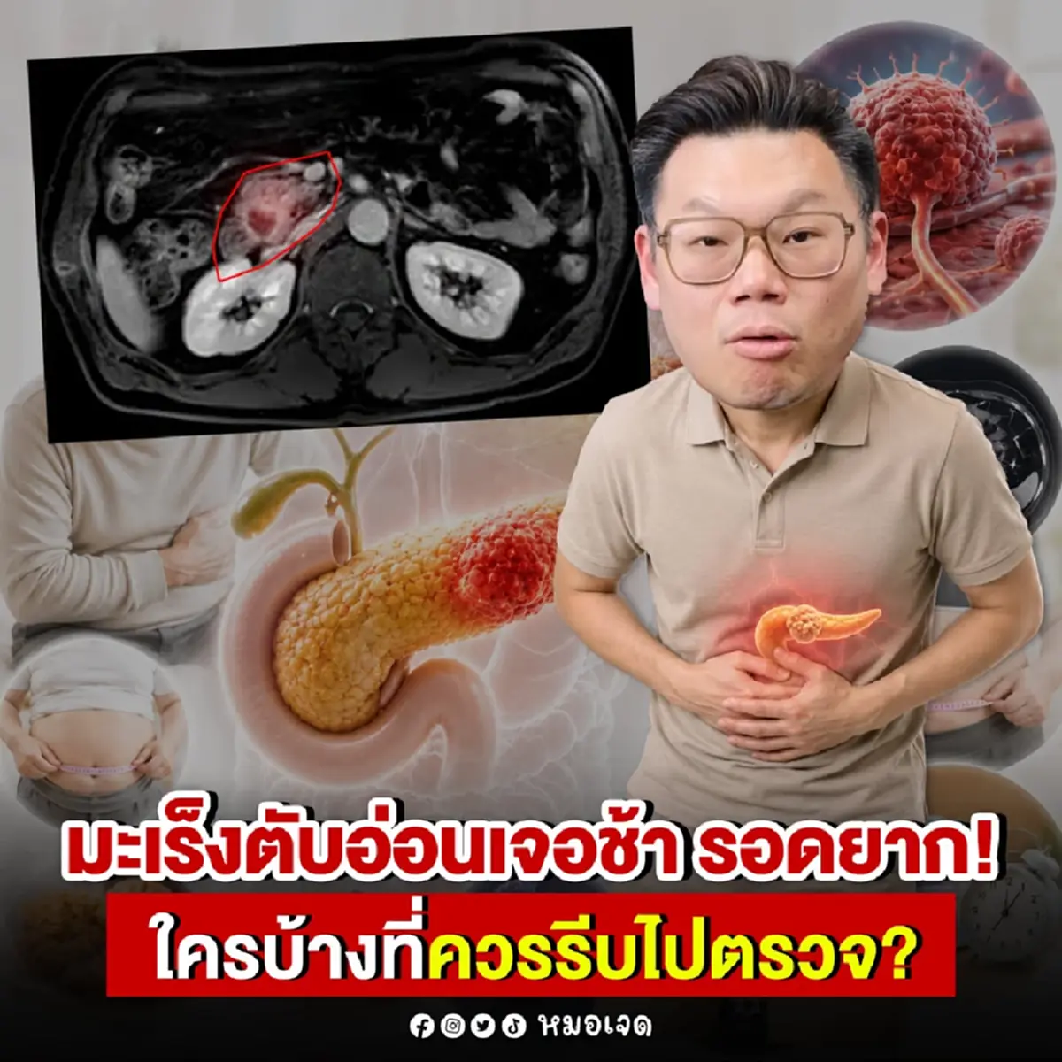 "คน7กลุ่ม" ดังนี้ ไปตรวจมะเร็งตับอ่อนด่วน หมอเผย เจอช้ารอดยาก 