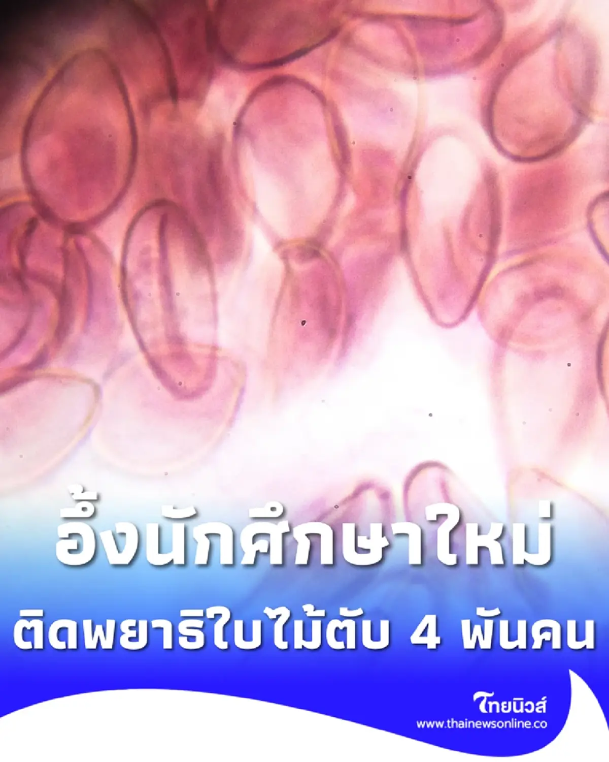 ตกใจ นักศึกษาใหม่ มมส. ติดเชื้อพยาธิใบไม้ตับ กว่า 4 พันคน 