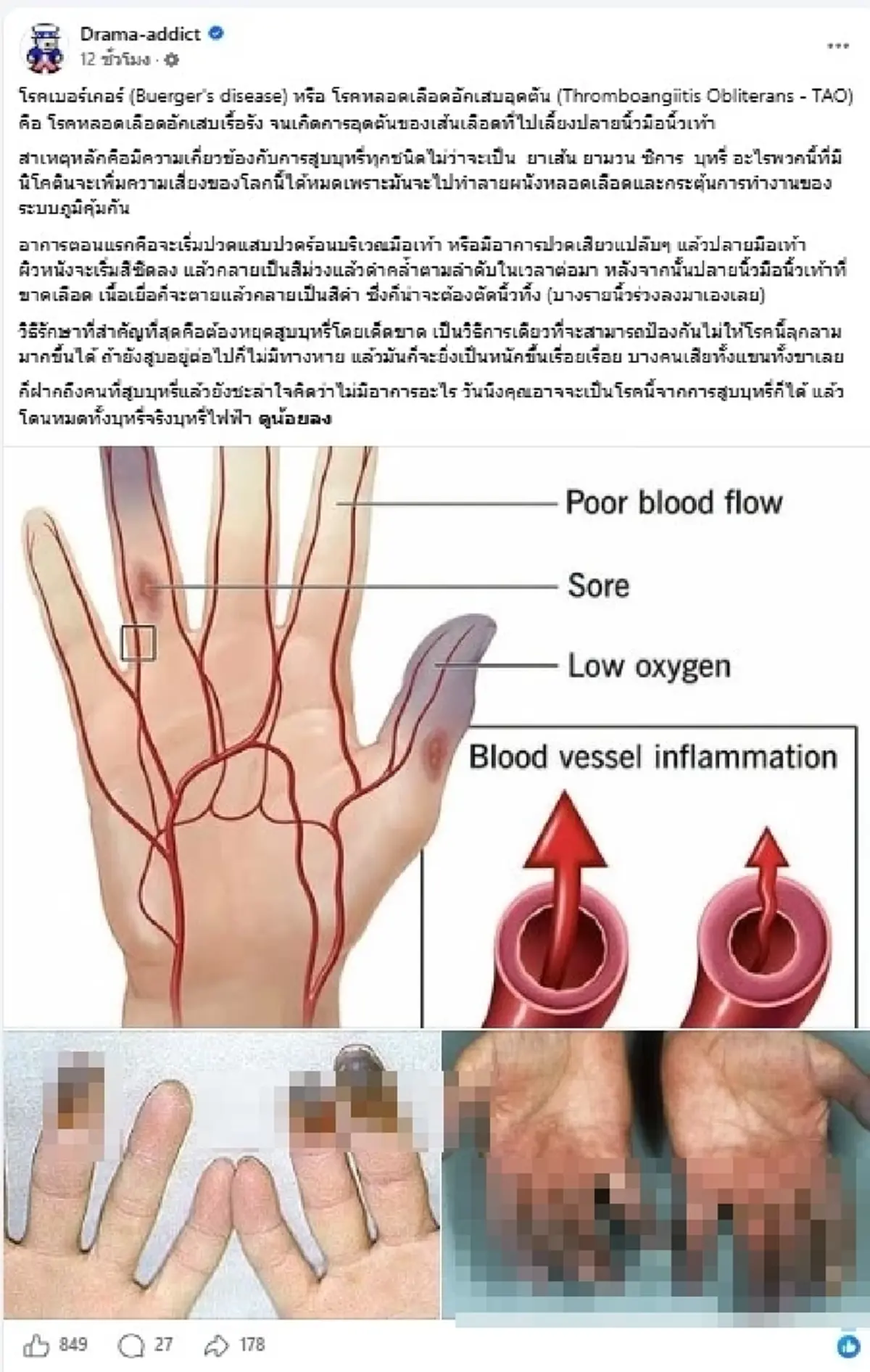 อย่าชะล่าใจ ปลายนิ้วดำ สัญญาณเตือนโรคร้าย คนสูบบุหรี่ต้องระวัง