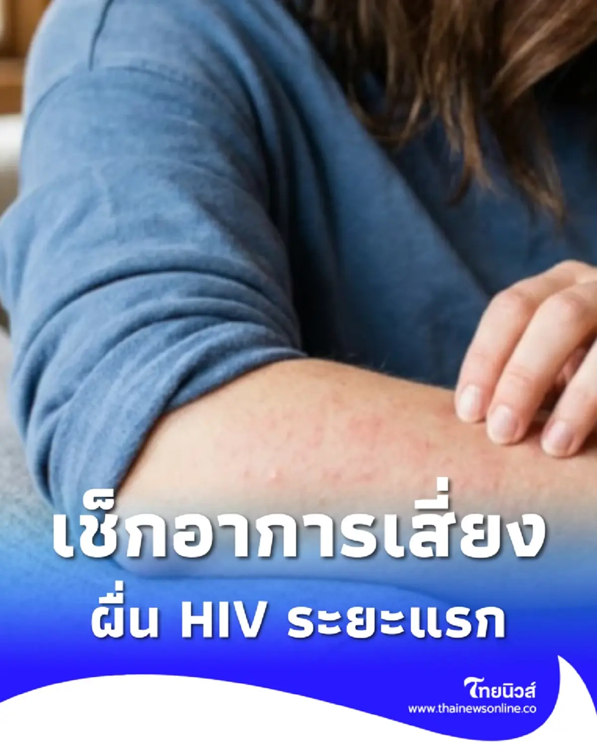 อาการ "ผื่น HIV ระยะแรก" เป็นแบบไหน รีบเช็กก่อนลุกลามไม่รู้ตัว