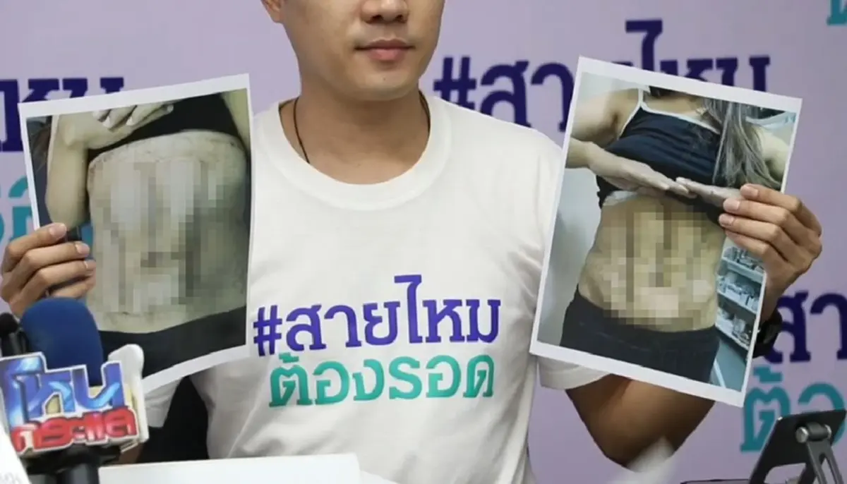 ดูดไขมันสยอง สาว 36 ทำร่อง 11 กลับกลายเป็นฝันร้ายตลอดชีวิต