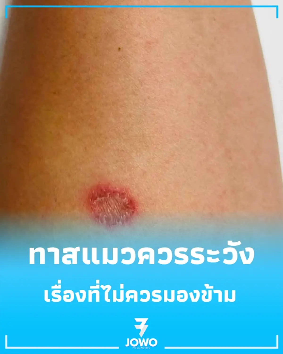 หมอเปิดเคส ชายไทยถูกแมวข่วนแค่ 2 แผล ผ่านไป 6 วัน แผลโตลามไม่รู้ตัว