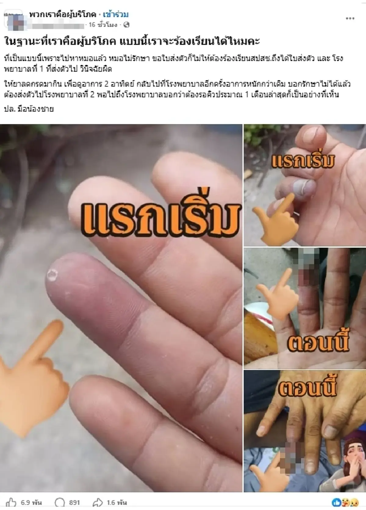 อย่าชะล่าใจ ปลายนิ้วดำ สัญญาณเตือนโรคร้าย คนสูบบุหรี่ต้องระวัง
