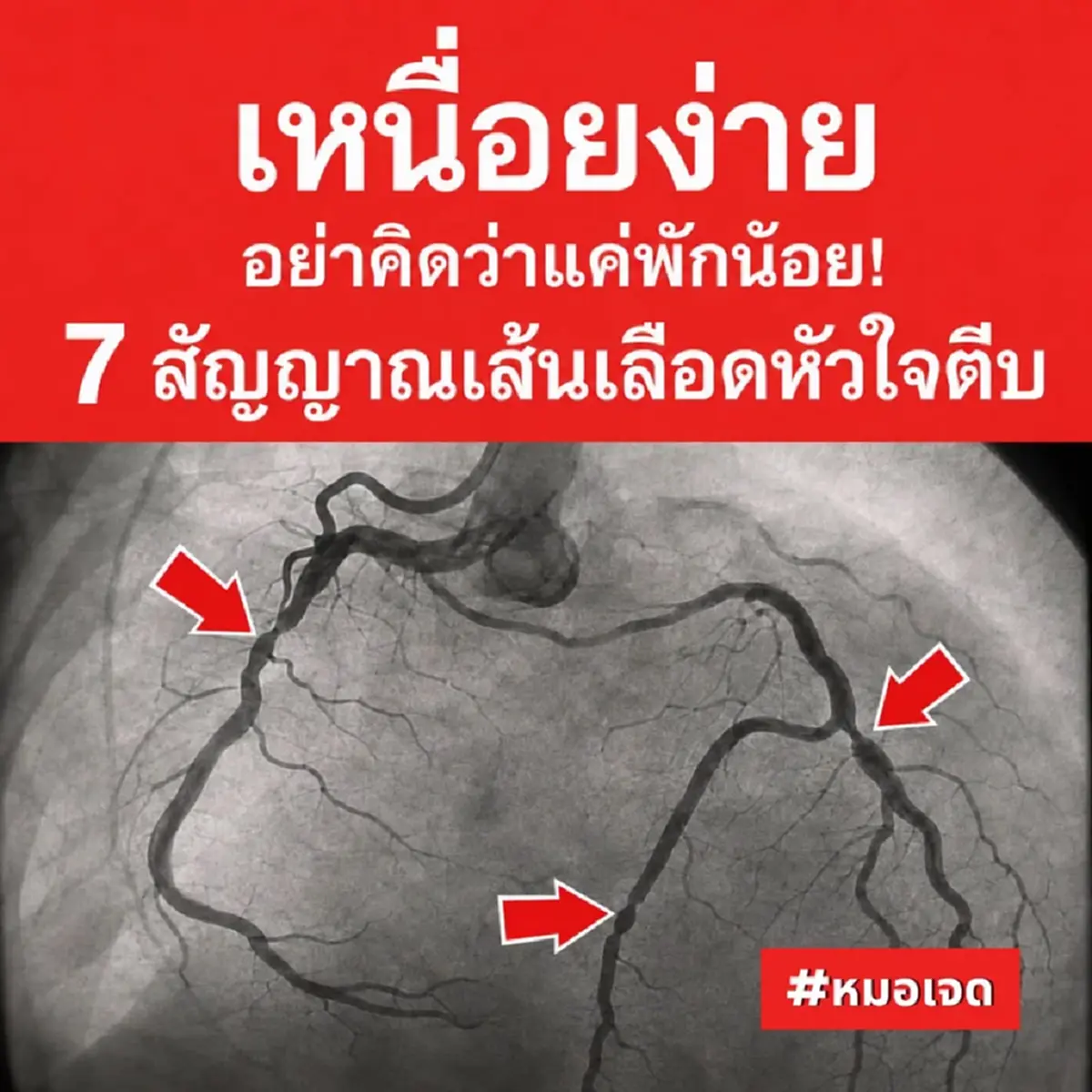 คิดว่าพักผ่อนน้อย ที่แท้เป็น "โรคหัวใจ" ถ้ามีอาการนี้ หาหมอเลย 