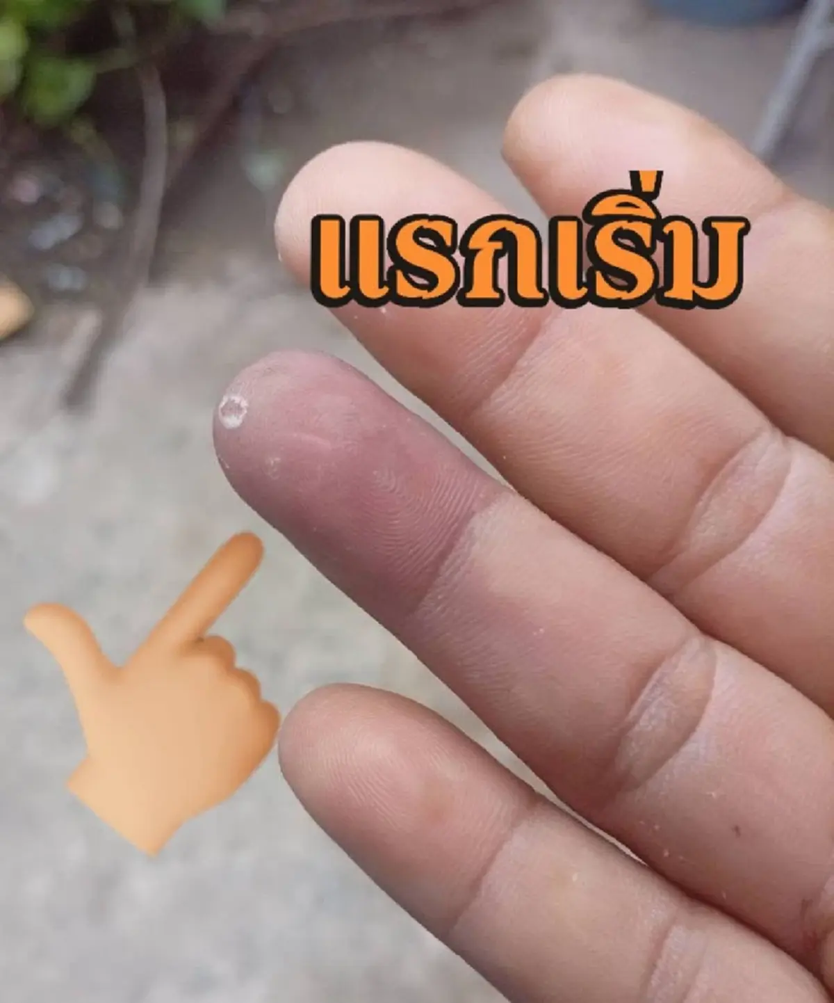 อย่าชะล่าใจ ปลายนิ้วดำ สัญญาณเตือนโรคร้าย คนสูบบุหรี่ต้องระวัง