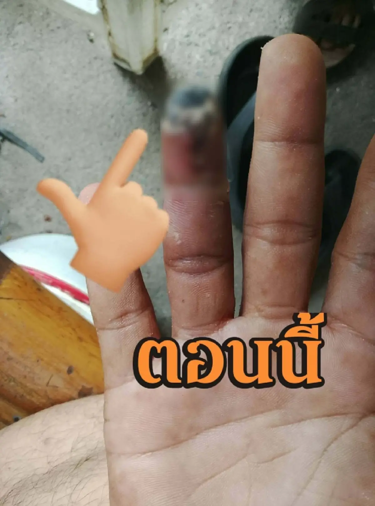 อย่าชะล่าใจ ปลายนิ้วดำ สัญญาณเตือนโรคร้าย คนสูบบุหรี่ต้องระวัง