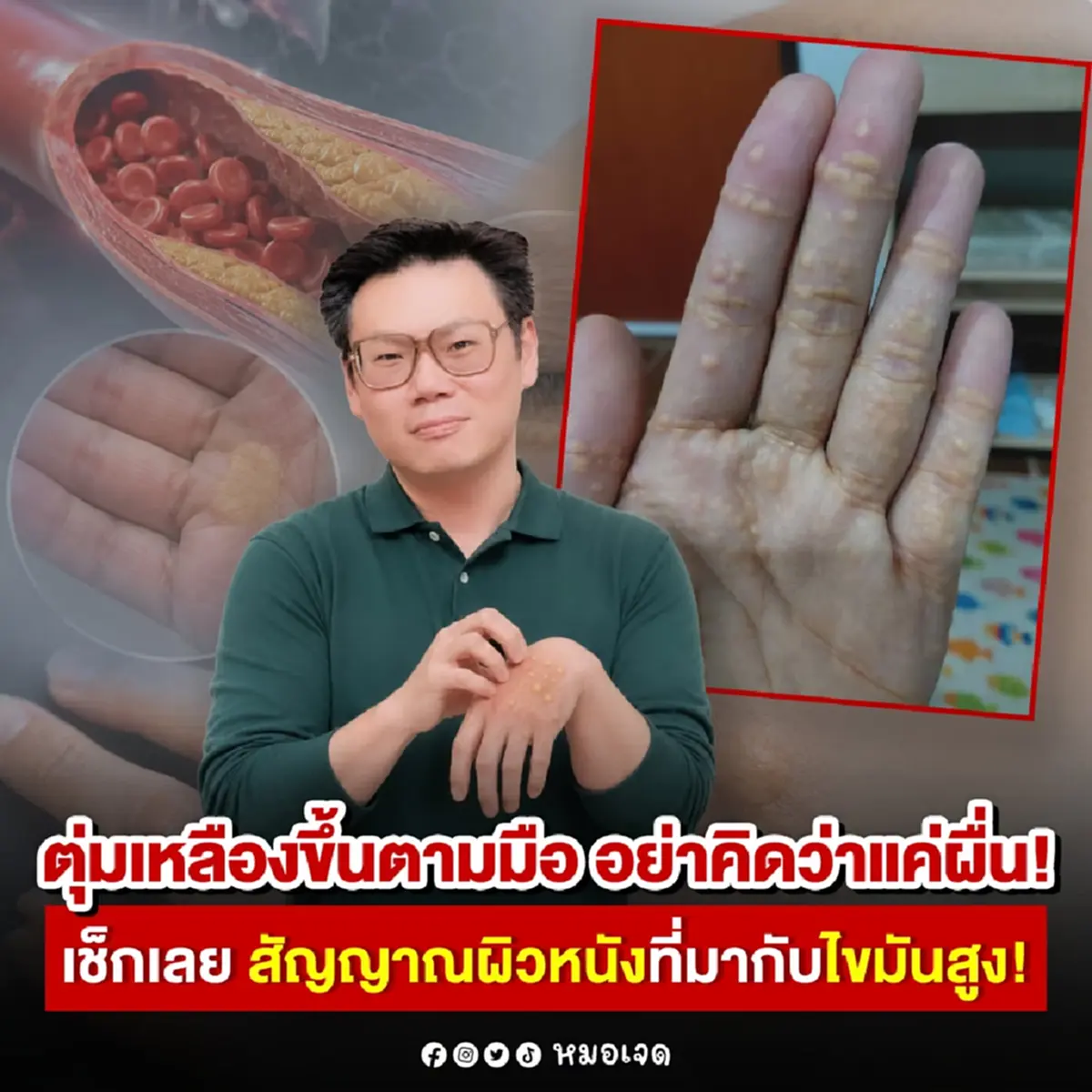 เตือน ตุ่มเหลืองขึ้นมือ อย่าคิดว่าแค่ผื่น ร่างกายส่งสัญญาณ แล้ว 