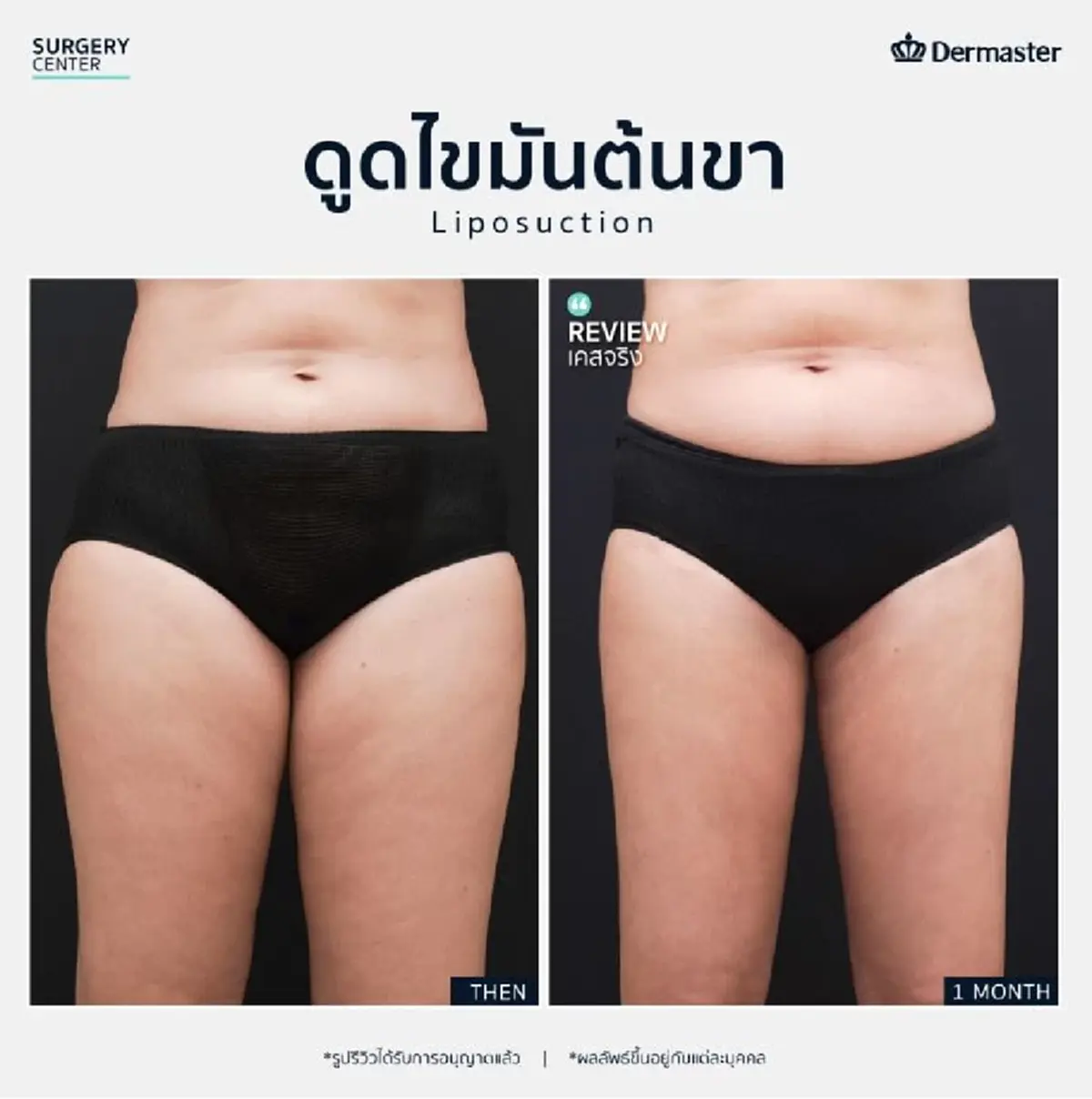 การเตรียมตัวก่อนดูดไขมันต้นขา