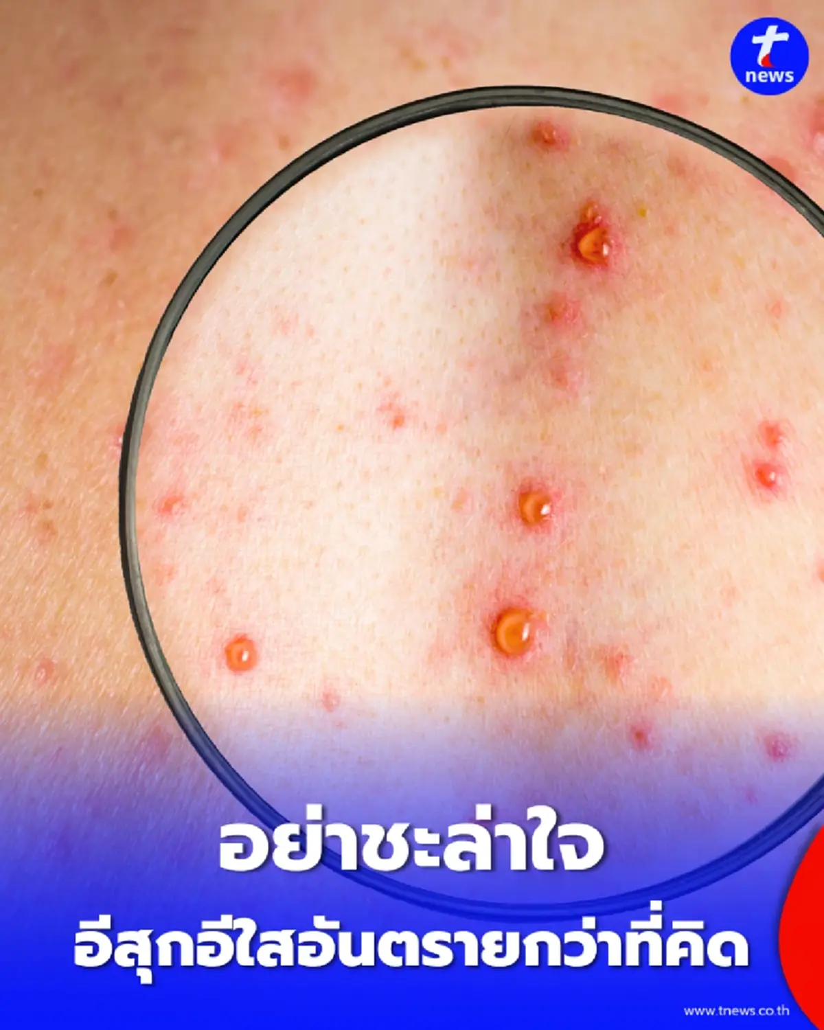 กรมควบคุมโรคเตือน โรคอีสุกอีใสในผู้ใหญ่ อันตรายกว่าที่คิดและเสี่ยงเกิดโรคงูสวัดตามมา