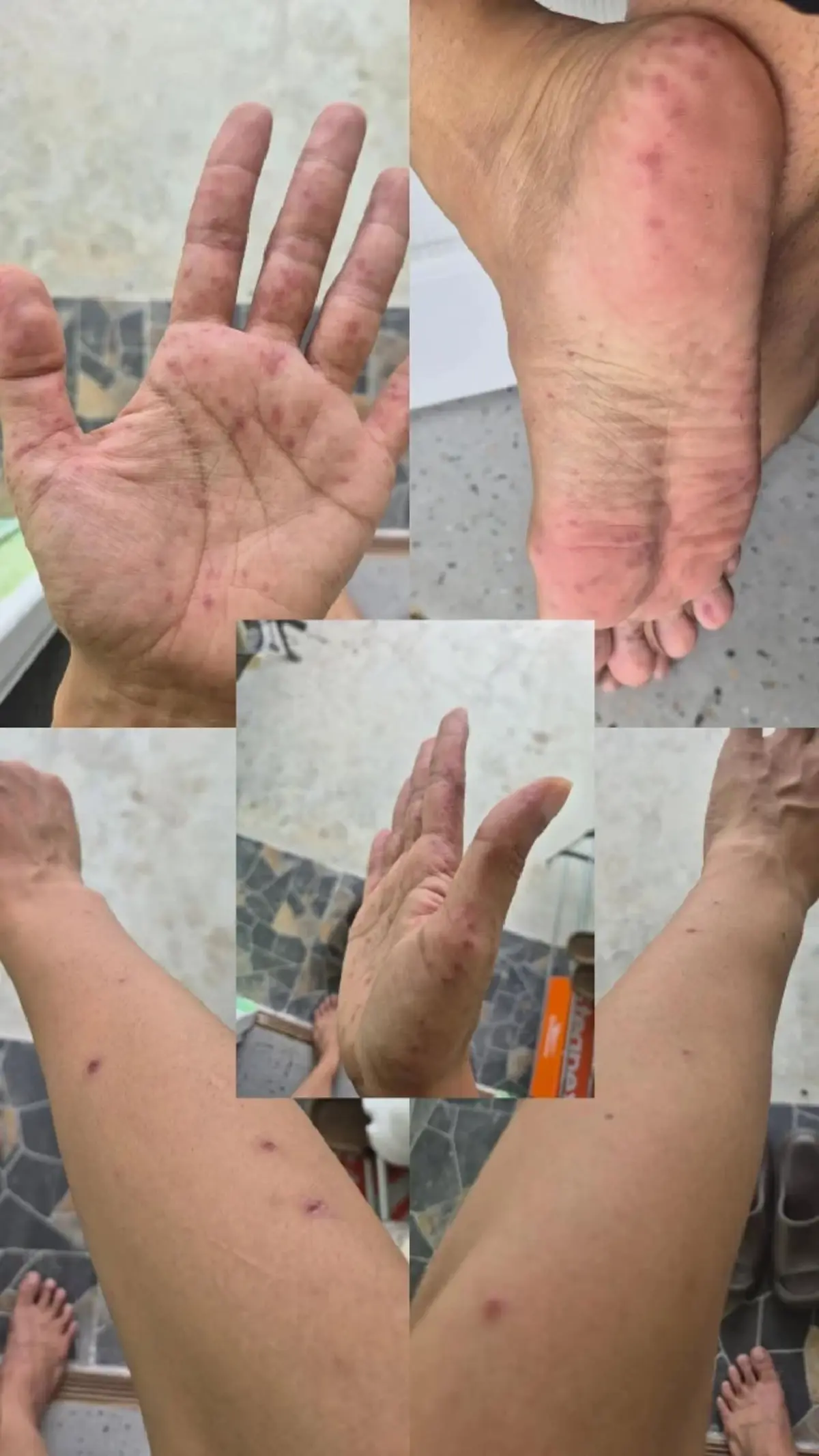 ใครจะคิด หนุ่มวัย 28 ป่วย "มือเท้าปาก" เข้าใจเลยเด็กทรมานขนาดไหน