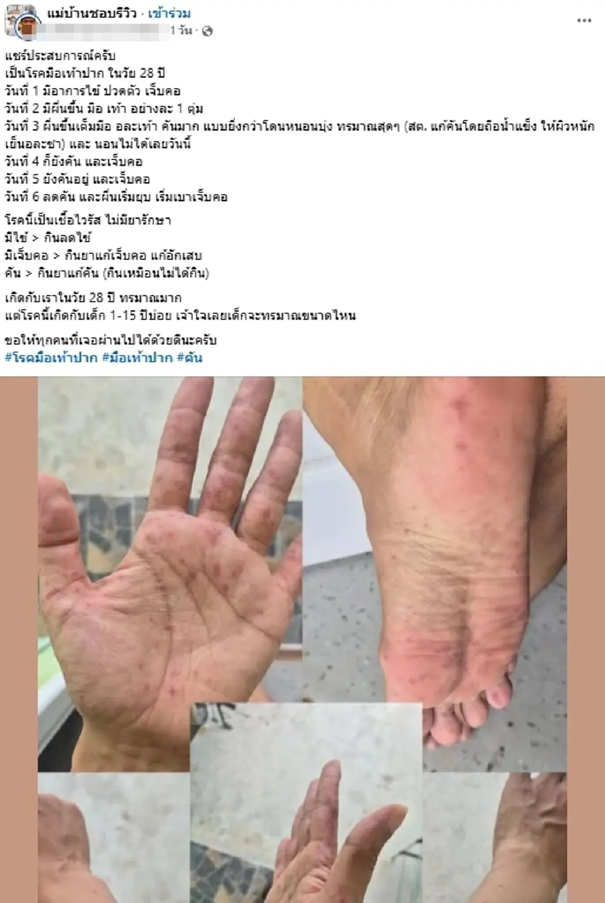 ใครจะคิด หนุ่มวัย 28 ป่วย "มือเท้าปาก" เข้าใจเลยเด็กทรมานขนาดไหน