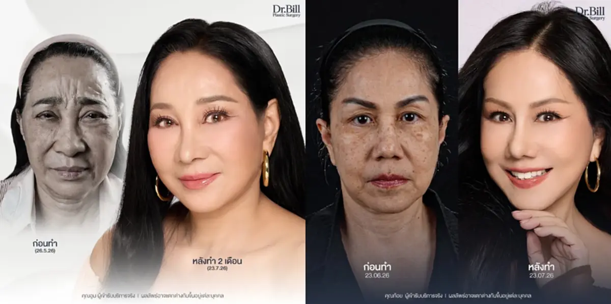 สองนักแสดงรุ่นใหญ่ ควงคู่ศัลยกรรมใหญ่รอบใหม่ สวยเป๊ะสมวัย