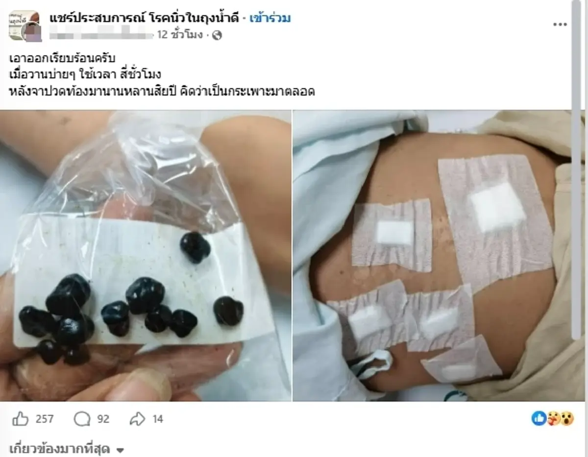 ถึงบางอ้อ ปวดท้องแบบนี้มาตลอด 10 ปี ที่แท้เป็นนิ่วเจอนับ 10 เม็ด
