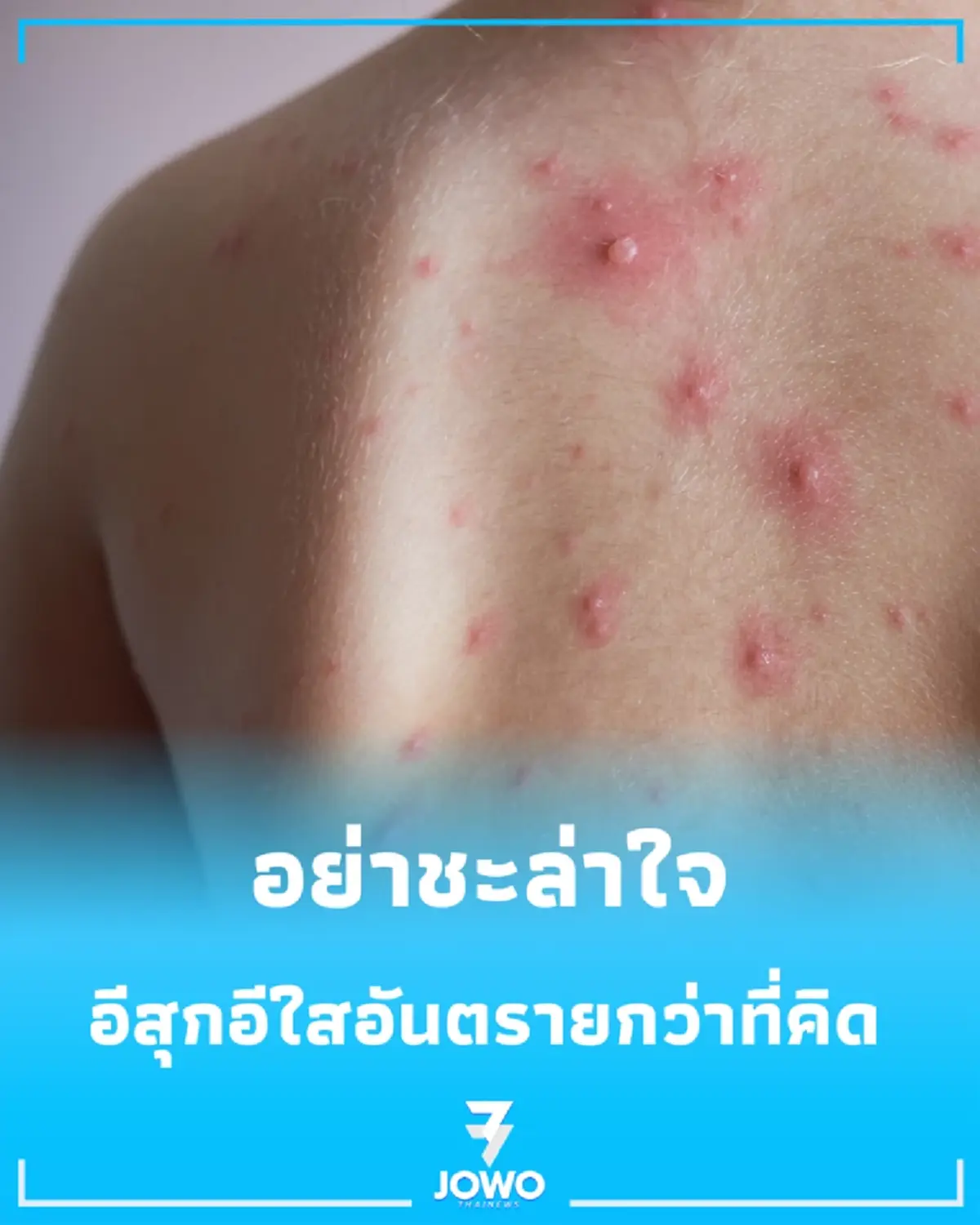 กรมควบคุมโรคเตือน โรคอีสุกอีใสในผู้ใหญ่ อันตรายกว่าที่คิดและเสี่ยงเกิดโรคงูสวัดตามมา