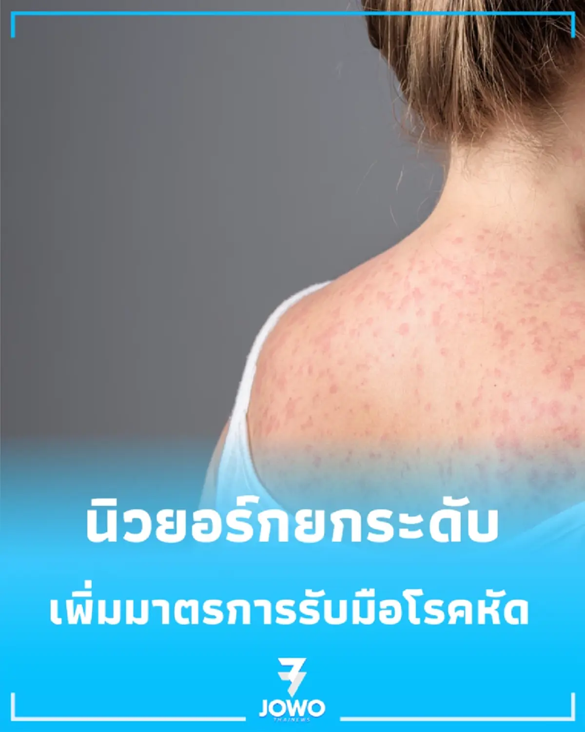 สหรัฐฯ เฝ้าระวัง นิวยอร์กยกระดับแผนรับมือโรคหัดระลอกใหม่