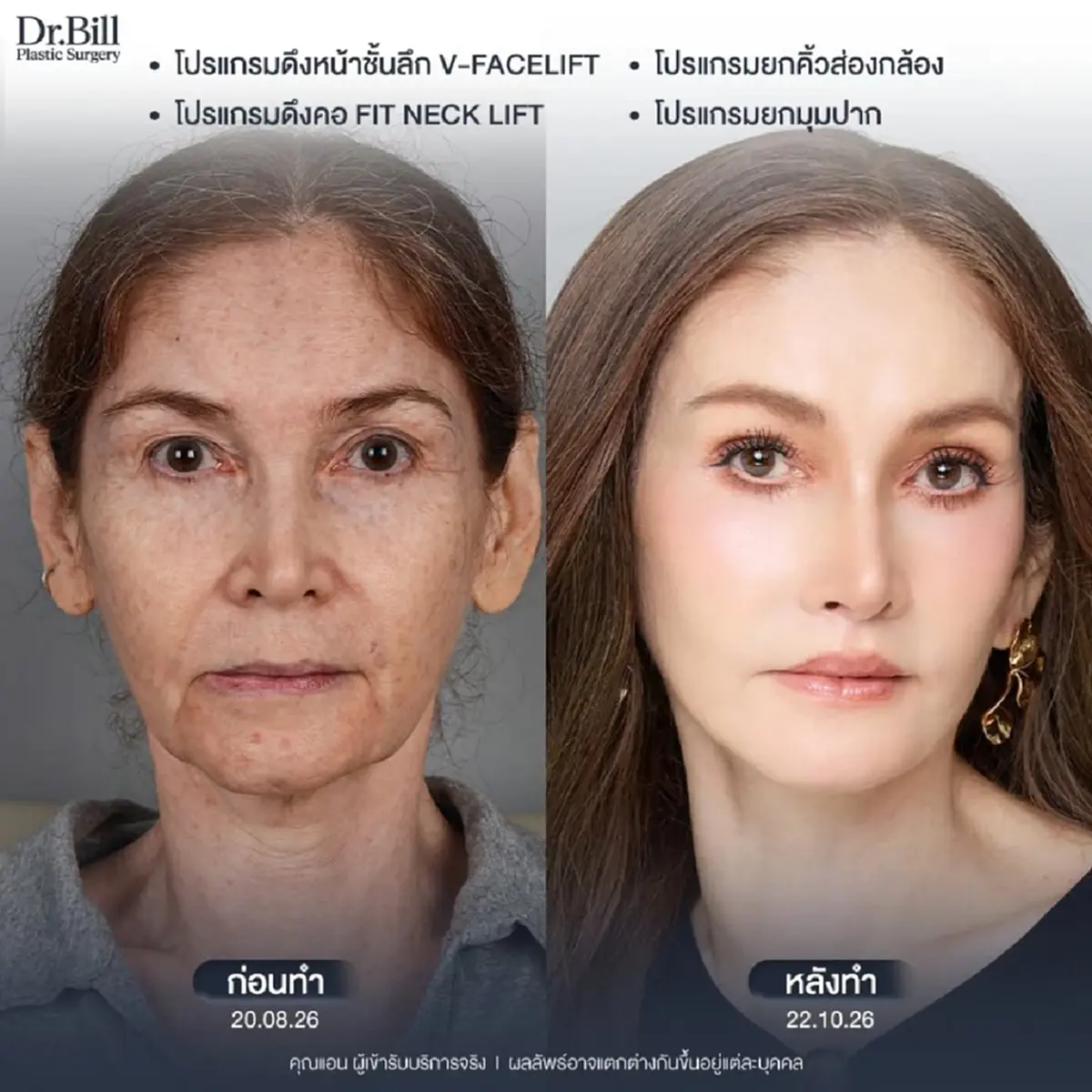 เผยลุคใหม่ว้าวมาก อดีตนางแบบดัง วัย 60 ตัดสินใจศัลยกรรมครั้งแรก