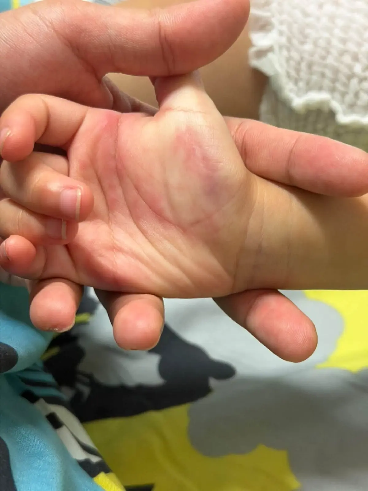 ใครจะคิด พาลูกเล่นทราย กลับมาคันหนัก สุดท้ายเจอพยาธิไชมือ-เท้า