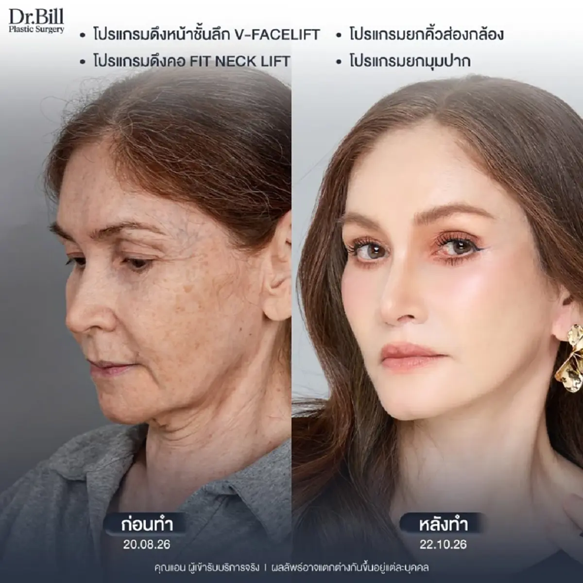 เผยลุคใหม่ว้าวมาก อดีตนางแบบดัง วัย 60 ตัดสินใจศัลยกรรมครั้งแรก