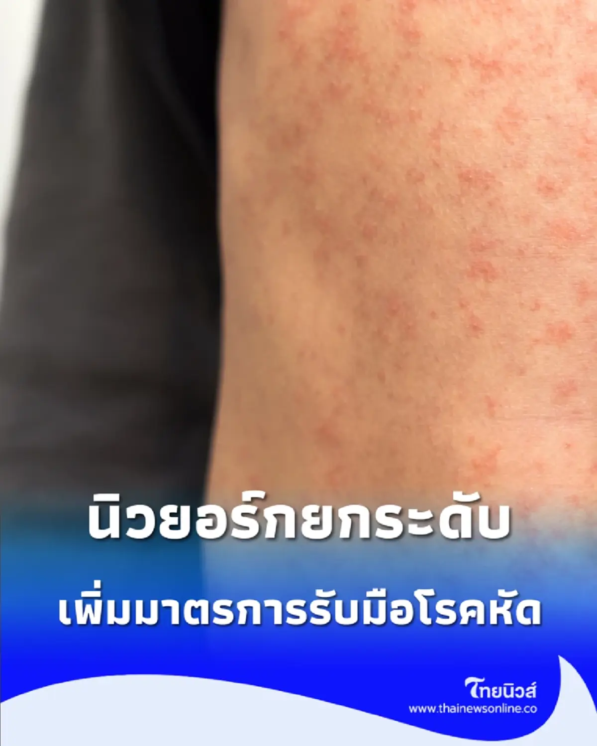 สหรัฐฯ เฝ้าระวัง นิวยอร์กยกระดับแผนรับมือโรคหัดระลอกใหม่