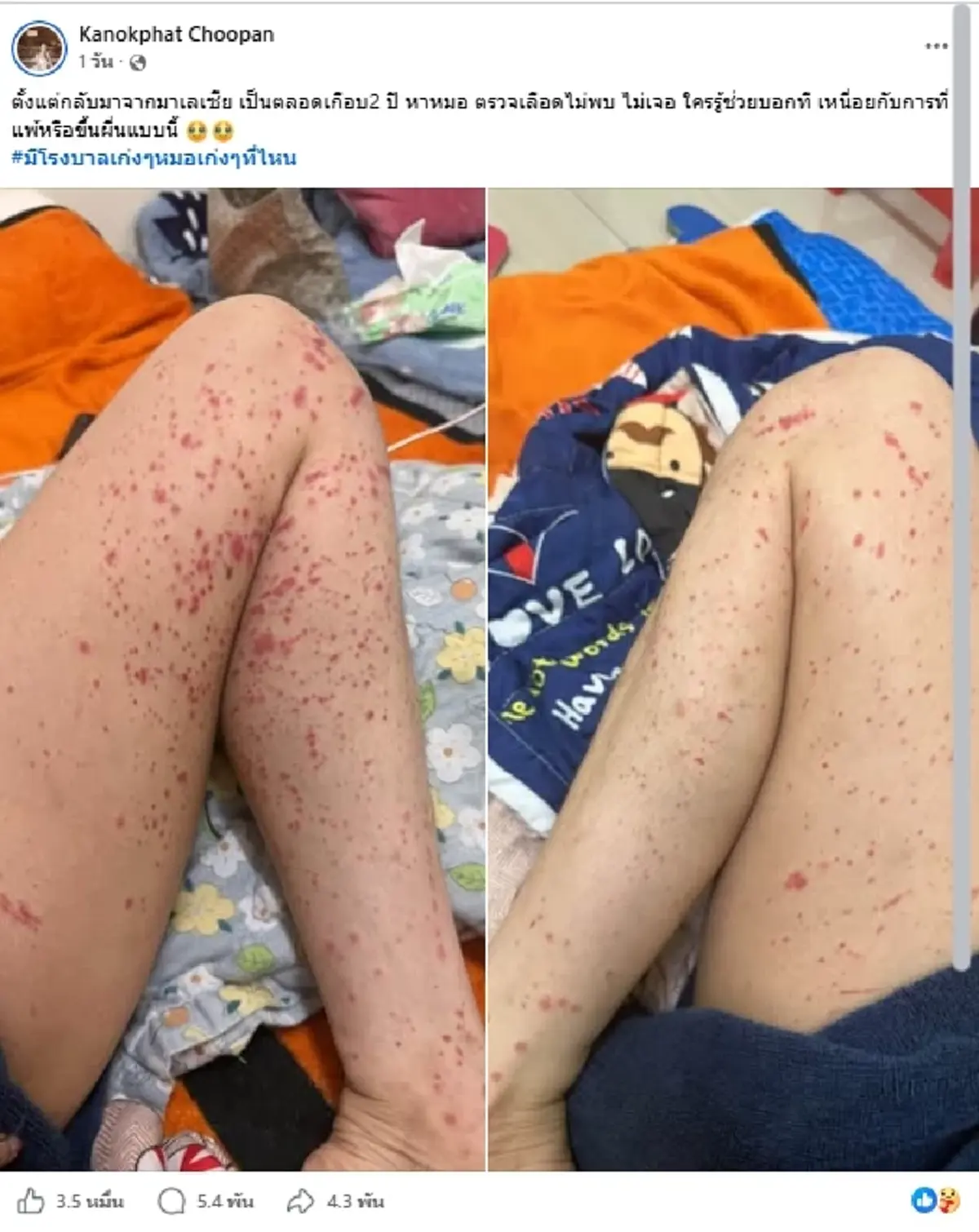สาวสุดท้อ ผื่นขึ้นไม่หาย 2 ปี ไม่เจอสาเหตุ หมอชี้โรคที่ต้องระวัง