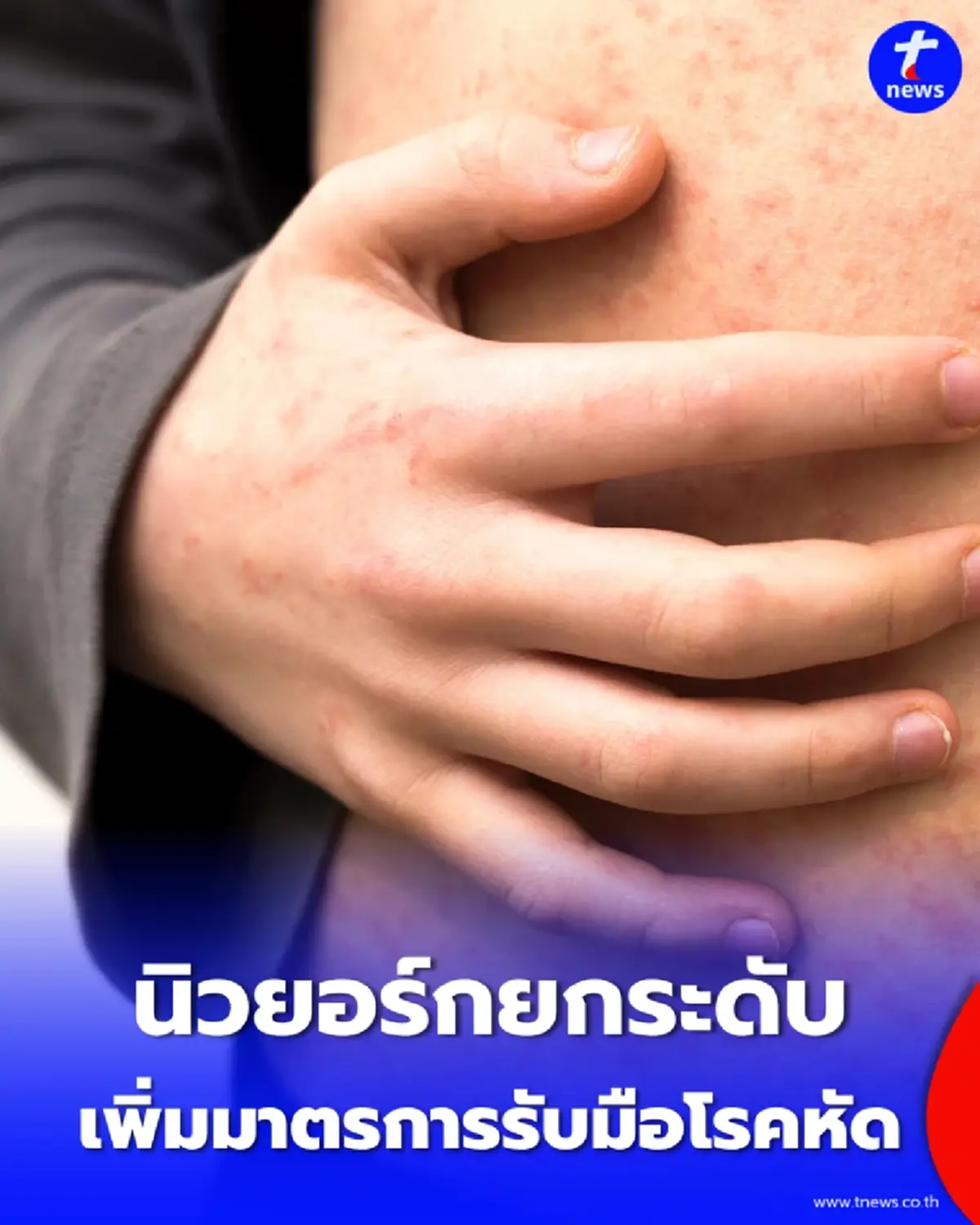 สหรัฐฯ เฝ้าระวัง นิวยอร์กยกระดับแผนรับมือโรคหัดระลอกใหม่
