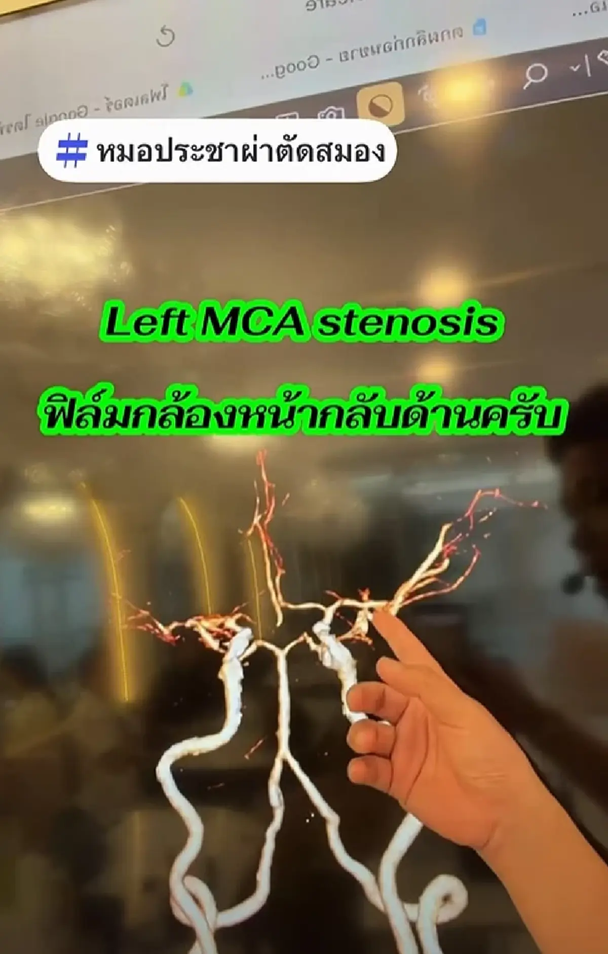 อาการนึกชื่อคน-ชื่อของไม่ออก อย่ามองข้าม ปล่อยไว้สมองอาจตายได้