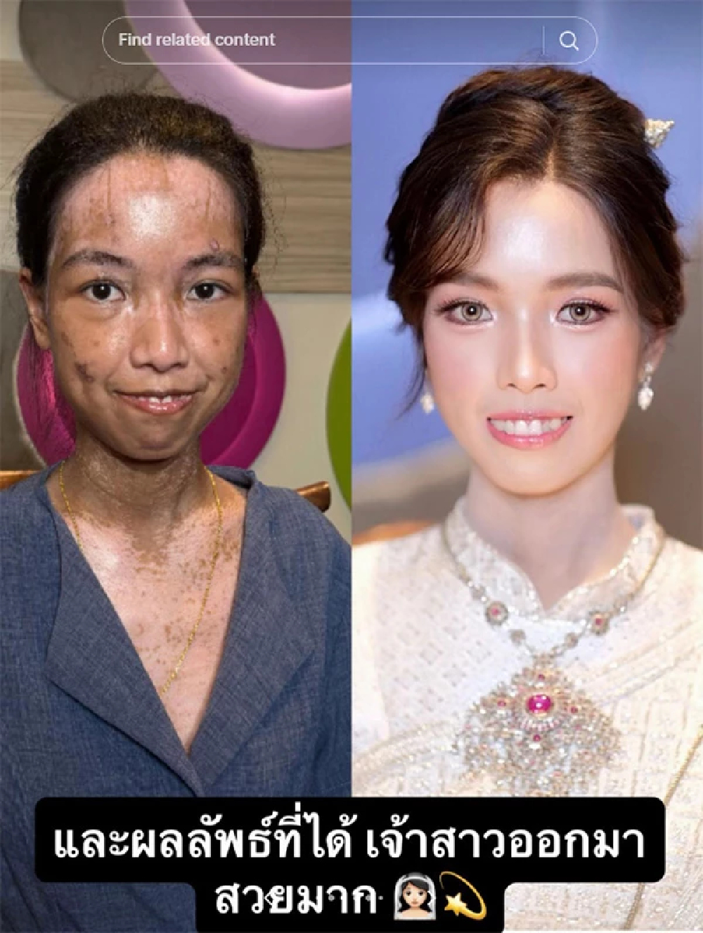 ชาวเน็ตทึ่งมาก ช่างแต่งหน้าทำผมชื่อดัง เนรมิตเจ้าสาวให้สวยสะพรั่งในวันแต่งงาน แม้มีรอยโรคปรากฏบนใบหน้า