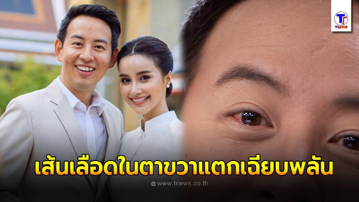 อาร์ม พิพัฒน์ เผยอุทาหรณ์ หลังขยี้ตา