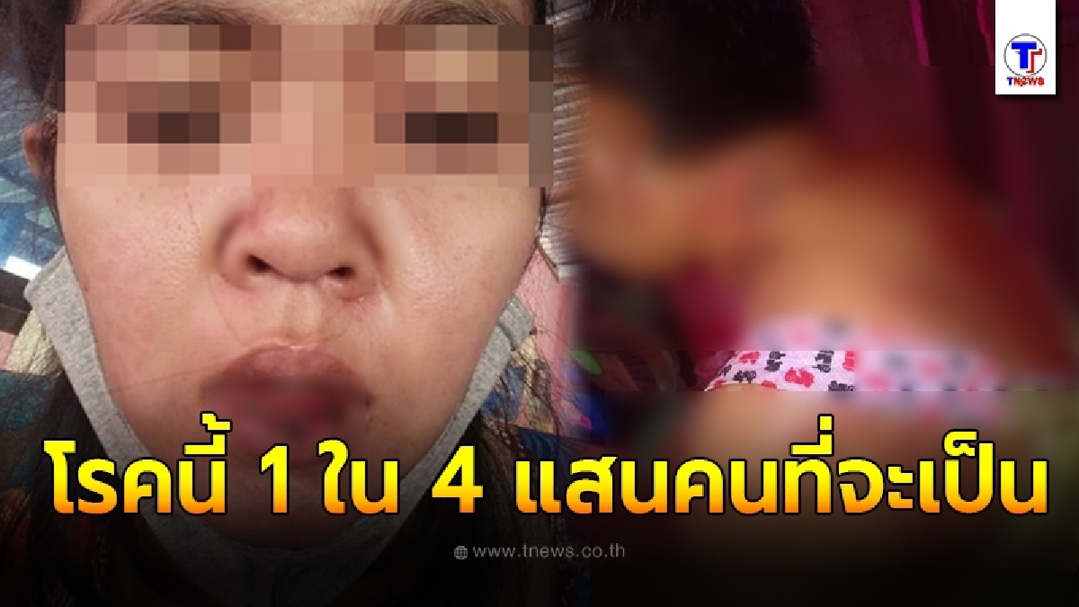 สาวแสนทรมาน มีตุ่มขึ้นปากเหมือนร้อนในก่อนลุกลามทั่วตัว เป็นโรค 1 ใน 4 แสนคนที่จะเป็น