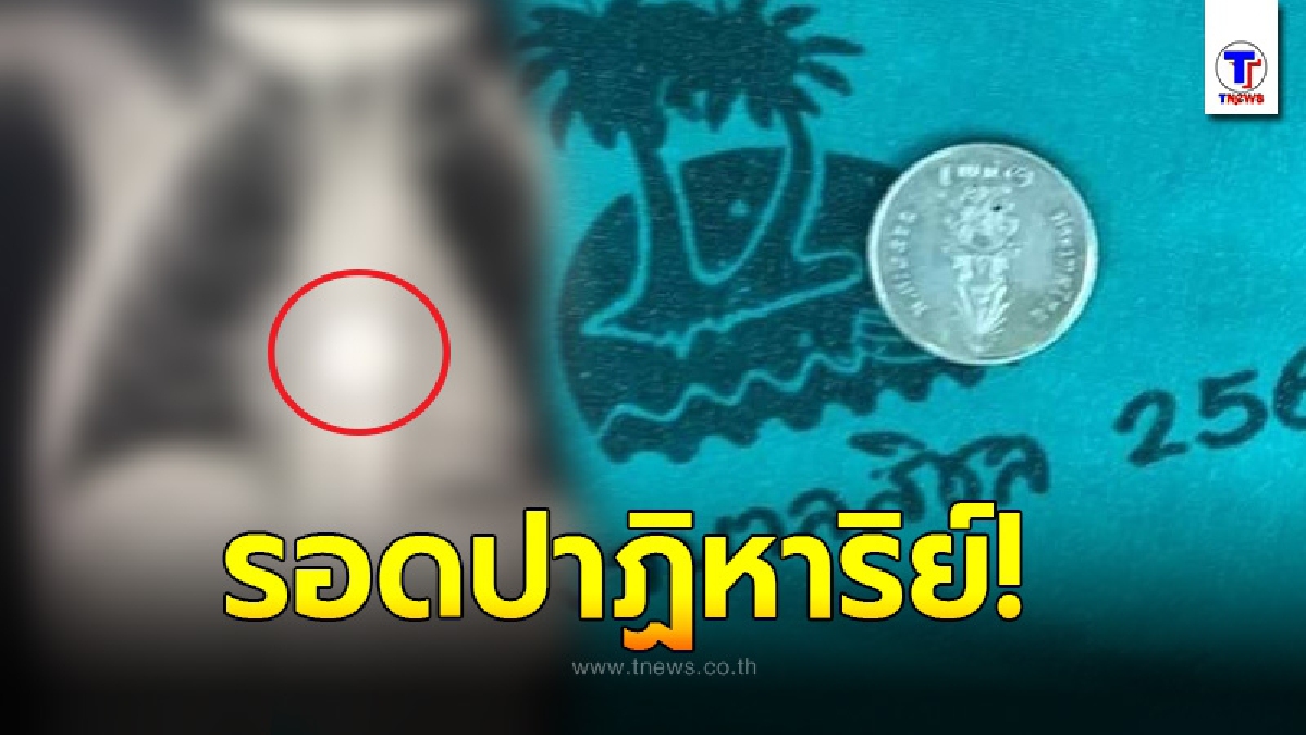 อุทาหรณ์ หนูน้อยวัย 2 ขวบ กลืนเหรียญบาทลงคอ ไปติดค้างในหลอดอาหาร